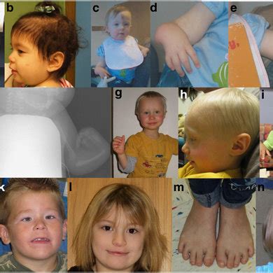 Characterized by epicanthal folds, a flat nasal bridge, broad hands and short fingers, a single crease in the upper palm (simian crease), a flattened forehead, small mouth, large tongue (macroglossia), and hypotonia. Flat Nasal Bridge And Epicanthal Folds : Clincal Features 1 Acrocephaly 2 Flat Nasal Bridge 3 ...