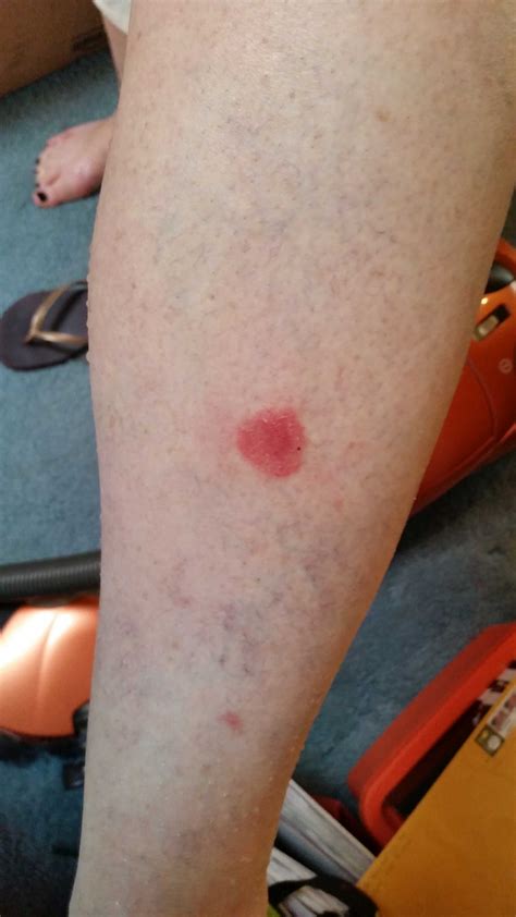 I have the same exact spots! Mom has a red spot on her leg. No pain or itchiness. What ...