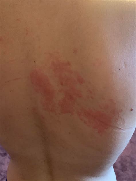 There's no cure for shingles, but prompt treatment with prescription antiviral drugs can speed healing and reduce your risk of complications. Turns out you can get shingles in your 30's if you're ...