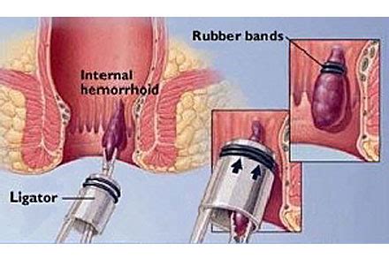 Does anyone have access to information regarding how long it takes for these sorts of things to return? How Long Do Hemorrhoids Last?