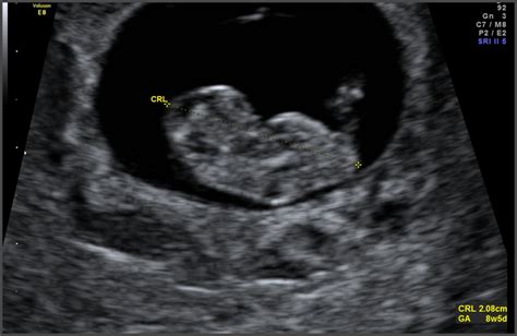 The dating scan is an ultrasound that can be done from seven weeks of pregnancy but they usually happen a little later. Can you have a dating scan at 8 weeks. Can you have a ...