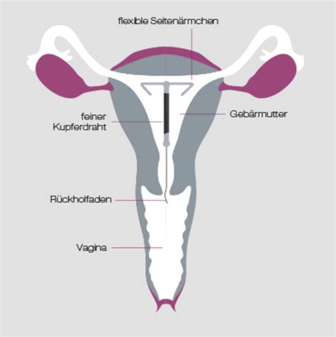 · am besten funktioniert das spirale entfernen waumlhrend der periode da der muttermund zu dieser. 34 HQ Photos Ab Wann Wirkt Die Kupferspirale : Gynefix ...