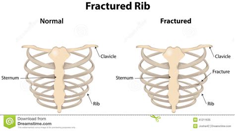 It provides a strong framework onto which the muscles of the shoulder girdle. Rib Cage mit einem Bruch vektor abbildung. Illustration ...