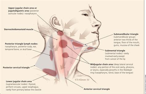 The front neck muscles become weak and stretched out, and the back neck muscles become very tight. Swollen node in neck painful.