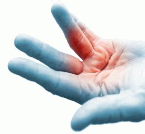 Morbo di Dupuytren | Team Symcro, Specialisti Arto Superiore