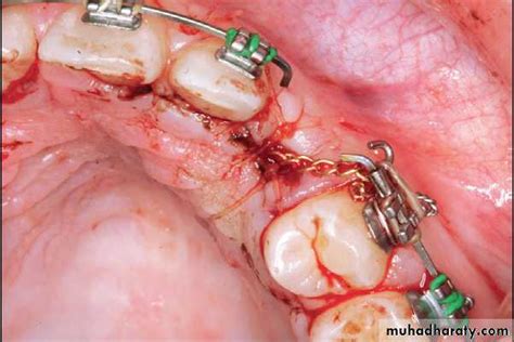 Patients were managed with open and closed eruption technique. Surgical orthodontics pptx - د.عمر وليد - Muhadharaty