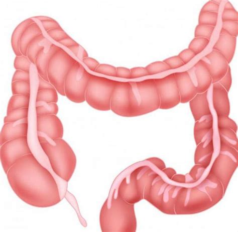 Learn what to discuss with your doctor and the importance of screening. colon transverso: su estructura y tipos de enfermedades