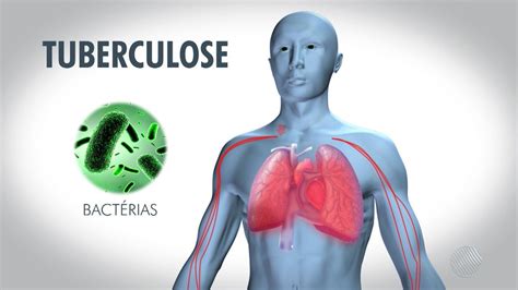 La esclerosis lateral amiotrófica (ela) (también conocida como la enfermedad de lou gehrig) es una enfermedad de las las células que controlan la actividad muscular voluntaria (neurona motora), progresiva, que causa problemas con el control muscular y el movimiento. Tuberculose: saiba como ela é causada, sintomas e ...