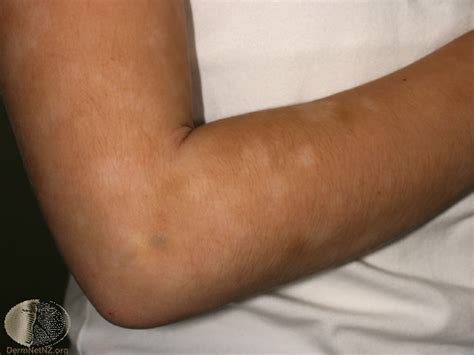 This appearance is known as pityriasis versicolor alba. Pityriasis Alba Photo Gallery | Dr Dilshaad Asmal ...