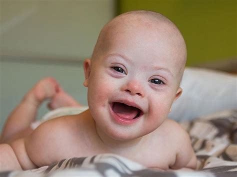 Down syndrome is a condition that is often associated with mental retardation. 'We Must Let Them Live': States Outlaw Aborting Babies ...
