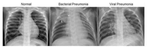 The dye is labeled glucose that concentrates in areas of elevated metabolism: Chest X-Ray Images (Pneumonia) - Academic Torrents