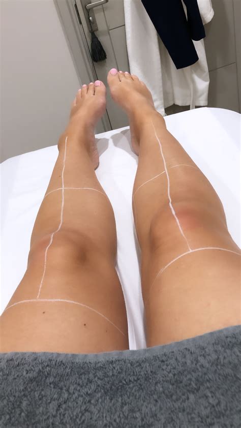 Now we recommend you to download first result joy revfa sofia by kevin pramono putra mp3. The Joy of going Hair-Free with Laser Leg Treatment at Spa ...