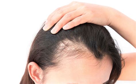 Hair loss occurs when new hair doesn't replace the hair that has fallen out. Autoimmune Diseases and Hair Loss | Specialty Infusion