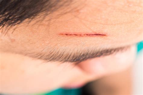 Deep lacerations go beneath the skin through the fat layer or to the muscle layer and may need medical help right away. Close Up Of Painful Wound On Forehead From Deep Cut Stock ...