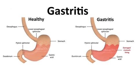 Gastritis akut disebabkan oleh mencerna asam atau alkali kuat yang dapat. C. Gangguan pada Sistem Pencernaan | Slide Set