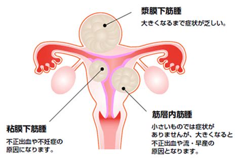 Definition of 子宮, meaning of 子宮 in japanese: 子宮筋腫｜公益社団法人 日本産科婦人科学会