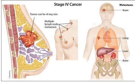 When the cancer cells start breaking away from the primary cancer area, they become part of the bloodstream and get dispatched to all over in the body. Metastatic breast cancer — Dr Ramawad Soobrah Breast ...