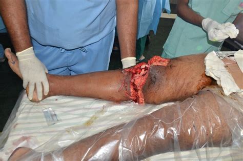 Open Degloving Injury Around the Knee - MediHelp
