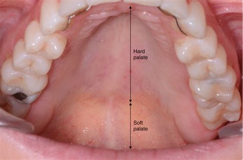 Ask your own oncology question. Hard and Soft Palate | SpringerLink