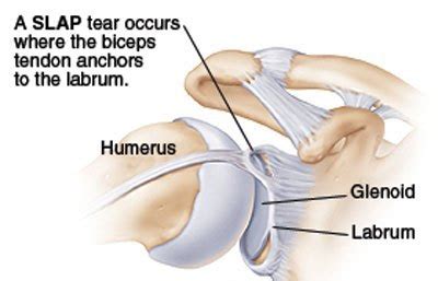 Diagnosing a labrum tear can be difficult and often requires a physical examination and diagnostic imaging. Slap Tear Symptoms, Causes & Treatment | Dr Kaushik Reddy