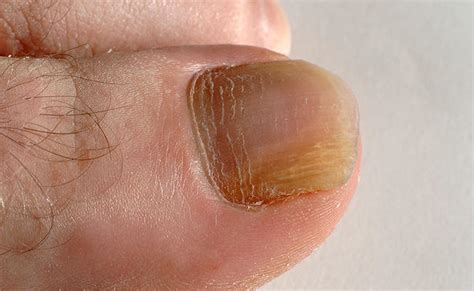 If untreated, it can expand and become a darker yellow/green colour that comes to discolour the hi, i'm gabrielle. How To Prevent Nail Fungus? - Complete Person