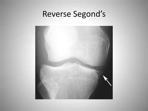PPT - Approach to the knee radiograph for bony injuries ...