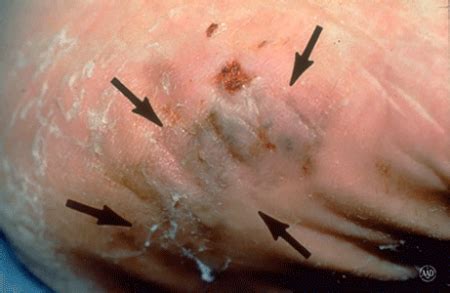 The most important sign of potential melanoma is a change in the skin's appearance, such as a change in an existing mole, or, more importantly, the appearance of a new spot. Melanoma: Signs and symptoms