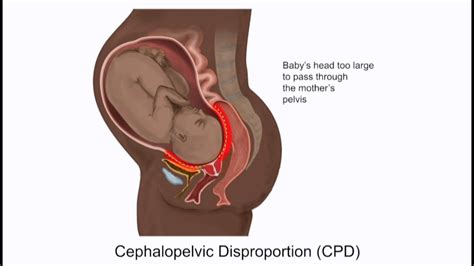 Birth date / birthdate is a compound noun and is a relatively recent and rare word. CEPHALOPELVIC DISPROPORTION ADALAH PDF