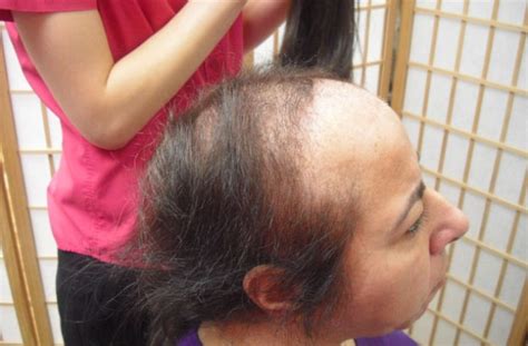 That is if you do not flick the scalp where you plucked the white hair from. 'My sons used to ask: Mummy why don't you have any hair ...