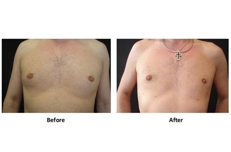 The gynecomastia surgery uk price depends on the procedure used in extracting fatty tissue and if there's any reconstruction involved. Gynecomastia Surgery | Male Breast Reduction | Gyno ...