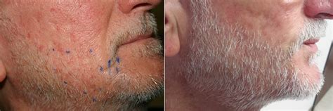 While the majority of hair transplant surgery is for the scalp, facial hair restoration and facial transplants including mustaches, goatees, beards, sideburns and eyebrows are growing in popularity. Facial Hair Restoration Patient 2 | Limmer Hair Transplant ...