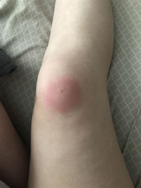 Most of the time, these lesions are bacterial infections like mrsa or streptococcus. What does a spider bite look like | 5 pictures what does ...