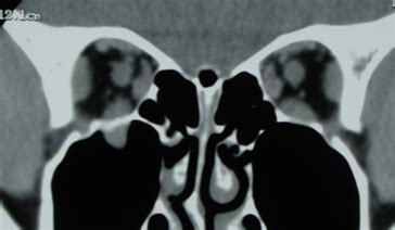 Photos of Trauma - Orbital and Zygoma Fractures | Eyelid ...