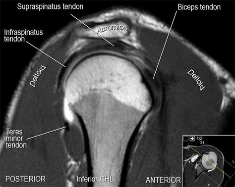 Sechrest, md narrates an animated tutorial on the basic anatomy of the shoulder. Related image | Shoulder anatomy, Supraspinatus tendon ...