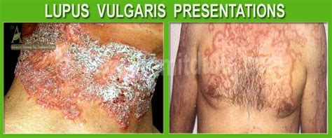 * forma luposa = granuloma es completo. Lupus Vulgaris - Dr. Amit Dutta. Best Ayurvedic Doctor ...