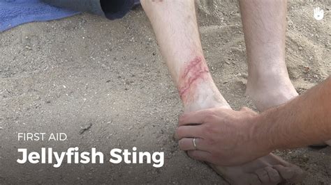First aid is when you tend to an injured or sick person in need of urgent medical assistance. First Aid: Jellyfish Sting | First Aid - YouTube