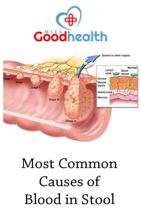 Signs and symptoms of colon cancer are often not specific, which means they may be mistaken for a number of different conditions. Blood In Stool From Hemorrhoids