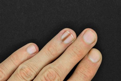Zmiany na paznokciach: co oznaczają białe plamy, bruzdy i paski? Po ...