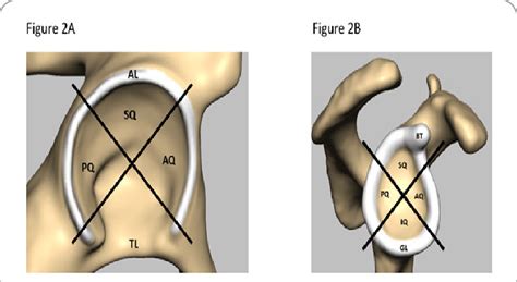 A labral tear occurs when the cartilage is torn. Labral quadrants of (A) the hip and (B) shoulder. A. AL: Acetabular... | Download Scientific Diagram