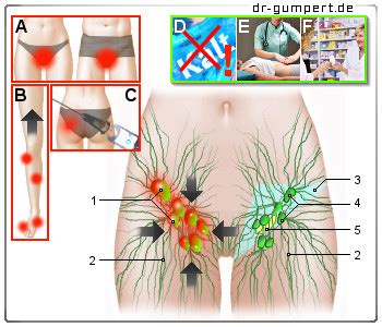 Einseitig geschwollen sind lymphknoten prinzipiell dann, wenn eine wunde, etwa durch kratzer beim spielen, die lymphe anregt. Lymphknotenschwellung in der Leiste - Gefährlich?