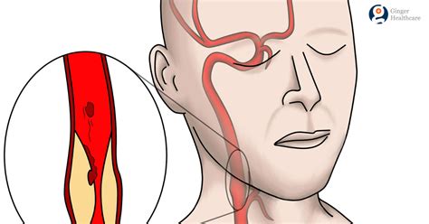 The common carotid artery sometimes follows a very tortuous course, forming one or more distinct loops in the neck. Carotid Artery Stenosis: What it is, how it is treated