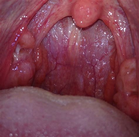 Early warning signs of bump in throat include neck or throat pain, weight loss, abrupt appearance, pain, choking, difficulty swallowing, spitting up food, muscle weakness, a mass that is visible or. What does throat cancer do