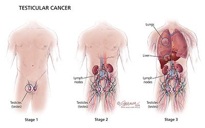 Knowing how all these parts feel will help keep you from confusing them with cancerous lumps. What are the Stages of Testicular Cancer? - Urology Care ...