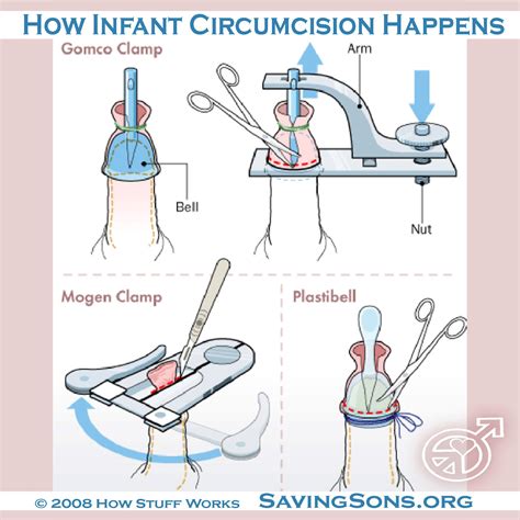 They're flattering to many body types, and they elongate your legs. The Circumcision Procedure | Cincinnati Tri-State Intactivists