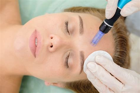Demonstrates a microneedling procedure with dermapen for effective acne scar reduction, collagen stimulation. Skin Needling Perth - Dermapen & Collagen Induction ...