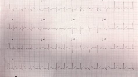 The most frequent ecg signs of myocarditis Myocarditis - Resus