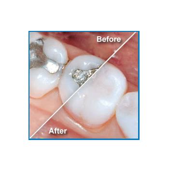 The material itself is weak and cannot be used in a thin layer. An Alternative to Silver Mercury Fillings