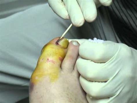 A hangnail can become infected if exposed to bacteria or fungus. Hang Nail Removal - YouTube