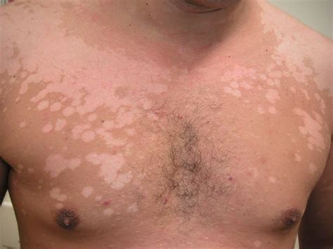 Hautausschlag auf grund von hefepilzen zeigt sich in etwa in schuppenden, farblich veränderten flecken, die sich wie bei der kleienpilzflechte (pityriasis versicolor) gleichmäßig ausbreiten. Pityriasis versicolor - Huidarts.com