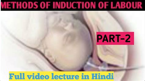 Place of induction(c) • induction of labour with vaginal prostaglandin can be conducted on antenatal wards for women who are healthy • for induction of labour in membrane sweeping (a) • should be offered prior to formal induction of labour • is not associated with increased risk of fetal or maternal. METHODS OF INDUCTION OF LABOUR II PART-2 II NATURAL METHOD ...